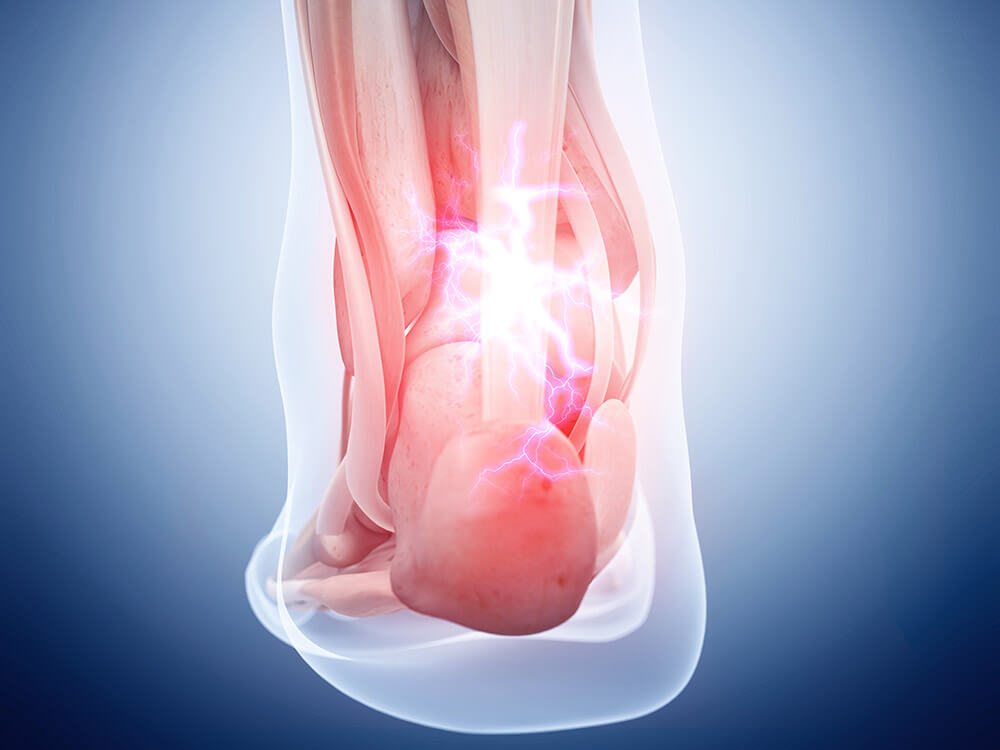 Illustration of Achilles tendon with pain depicted as electric bolts.